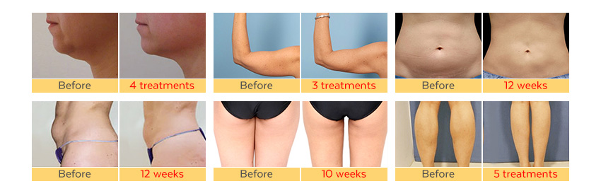 5 handles cryolipolysis machine effect 5 handles cryolipolysis machine effect