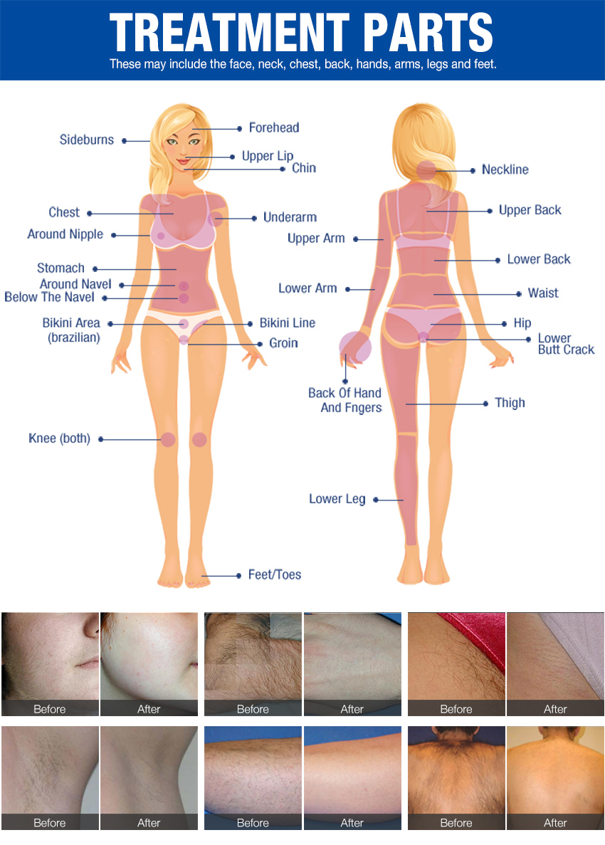 810 diode laser for hair removal 1200w machine treatment area