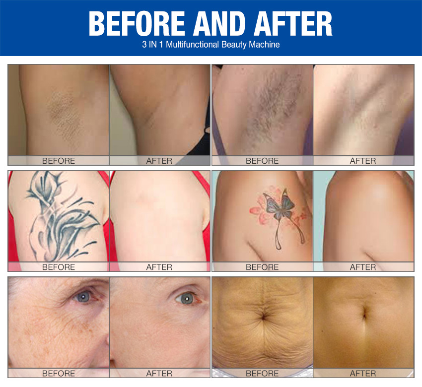 elight ipl rf nd yag laser multifunction machine