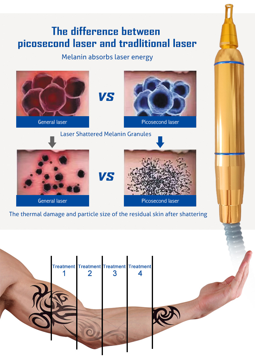 laser tattoo removal machine pen