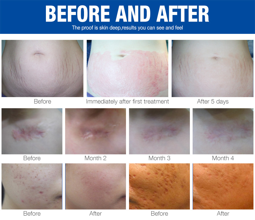 dermapen for acne scars before and after