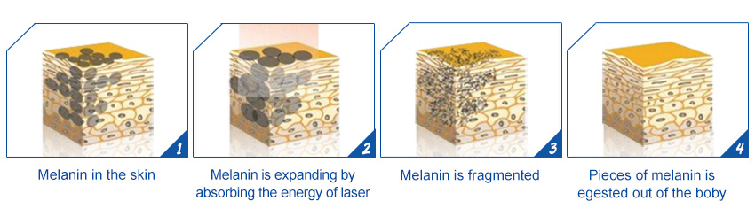 laser tattoo removal machine theory