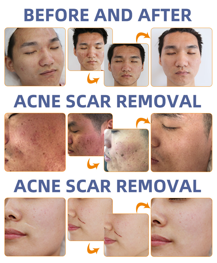 Fractional laser co2 skin resurfacing machine vaginal tightening tatoo acne scar removal