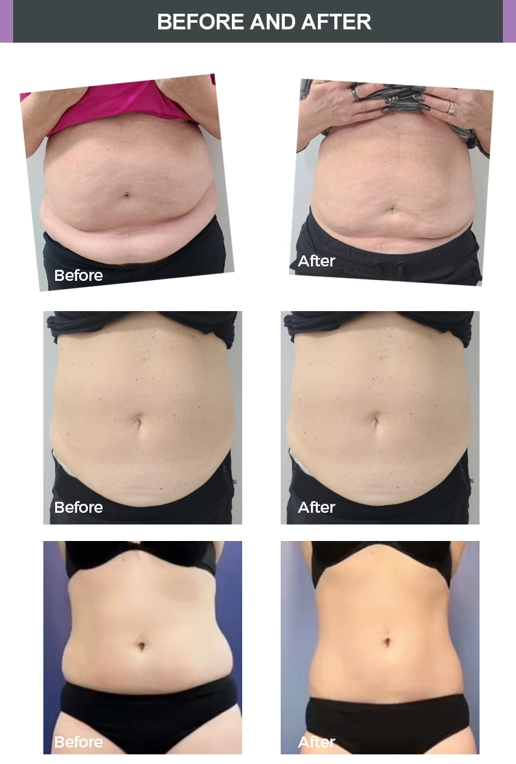 AngieFXSlim laser slimming machine