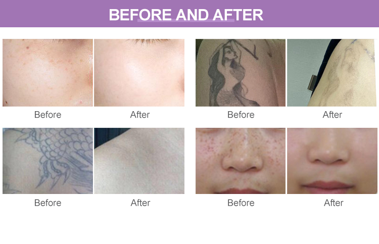 Portable Q Switched Nd Yag Laser Machine BM27