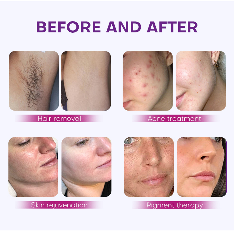 Long Pulse Light Ipl Machine