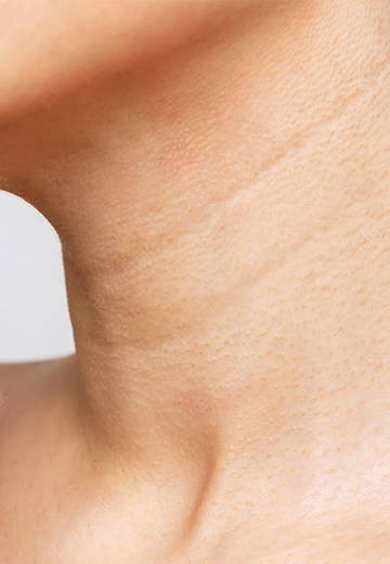 Double Chin Removal