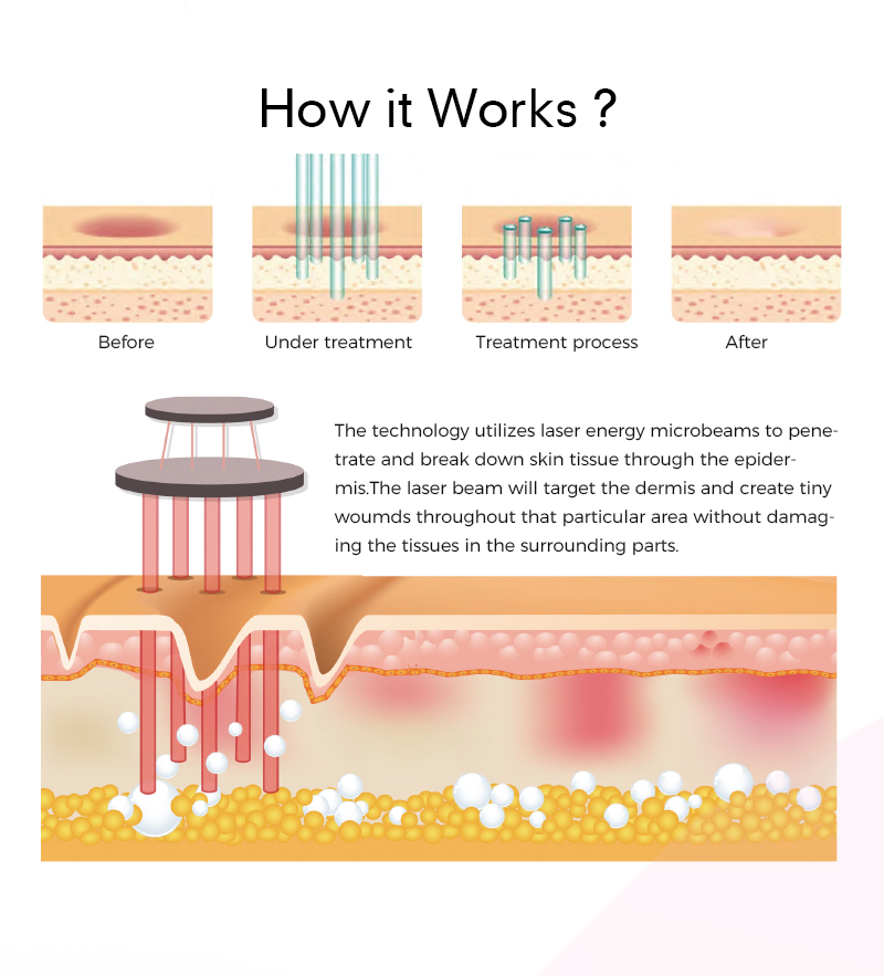 laser skin resurfacing machine