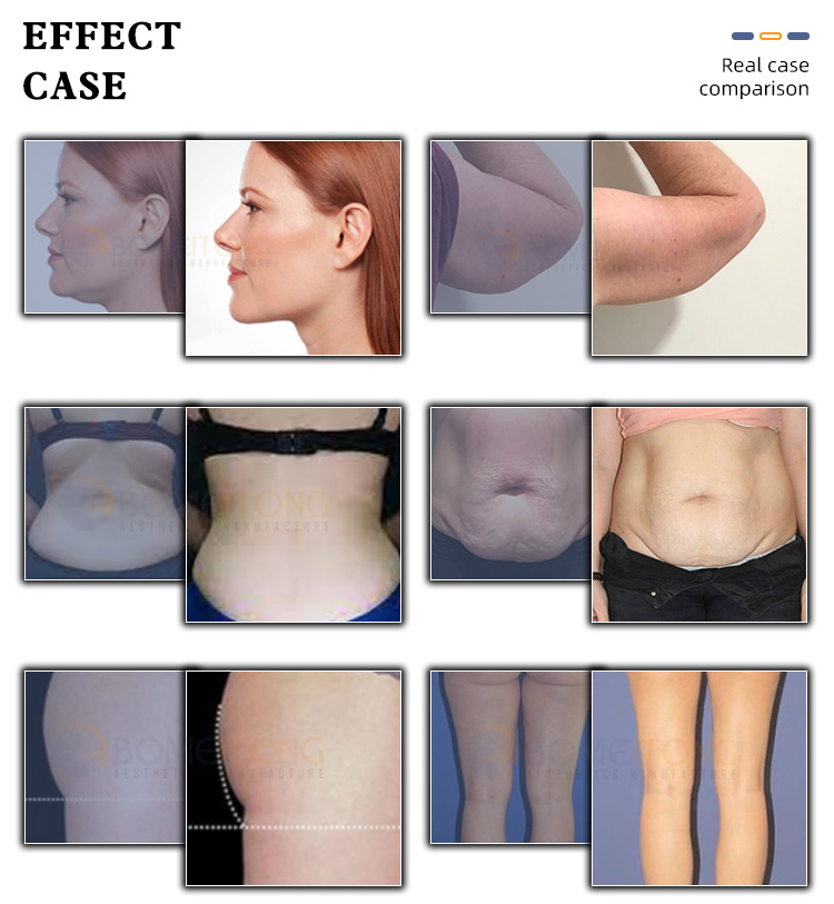 Professional fat freezing machine reduce cellulite removal slimming skin tightening