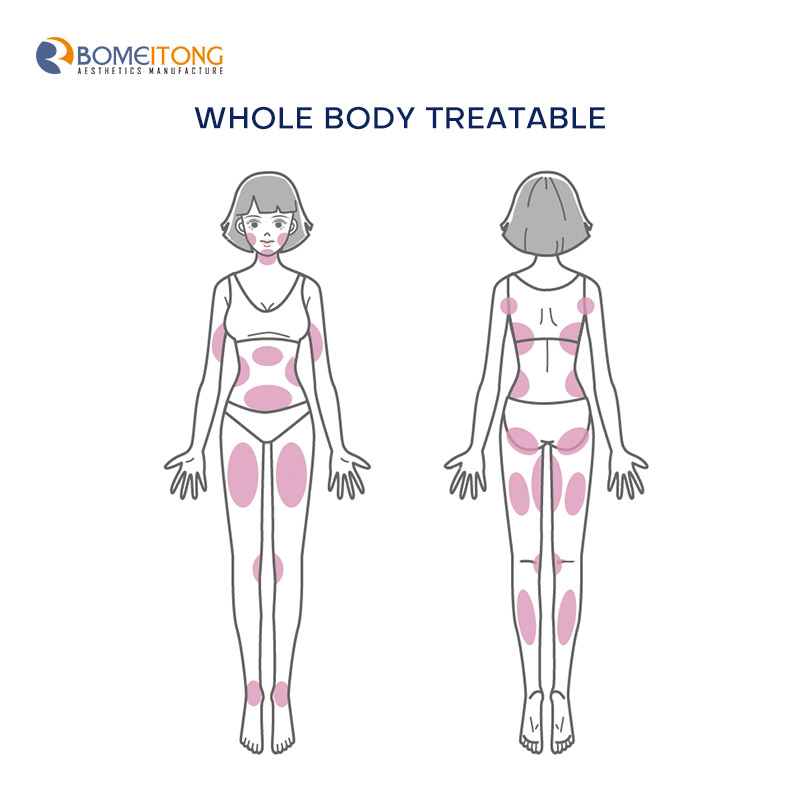 Vertical high intensity focused ultrasound hifu machine cost