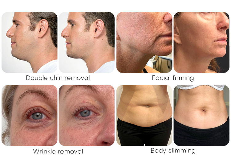 Best Ice Hifu Machine Professional 360&deg; +Lipo +Vaginal Hifu 5 In1