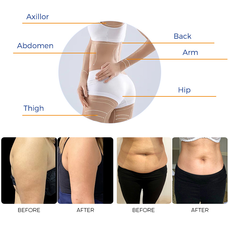 MPT HIFU 7D machine 2 in 1 FU3