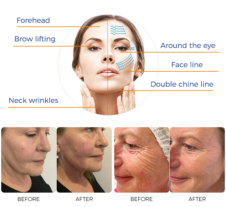 MPT HIFU 7D machine 2 in 1 FU3