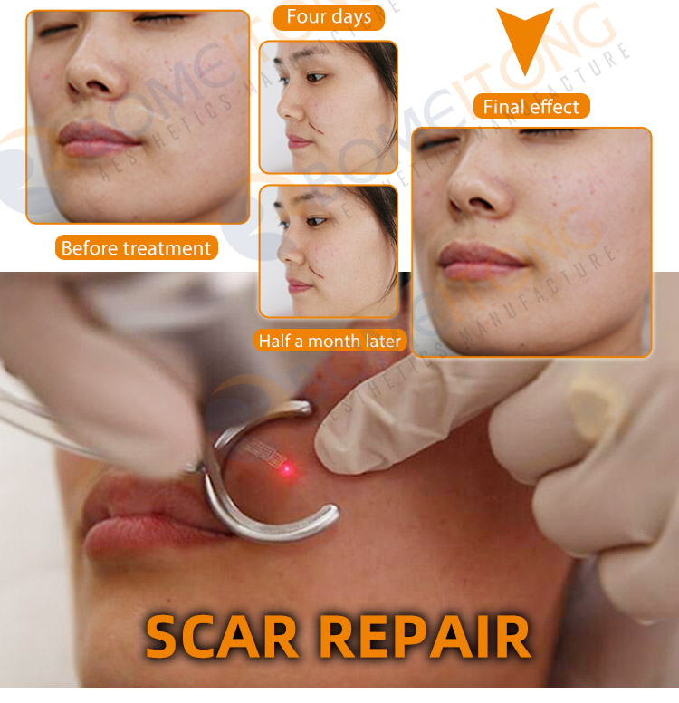 2021 co2 fractional laser skin rejuvenation vaginal tightening device small