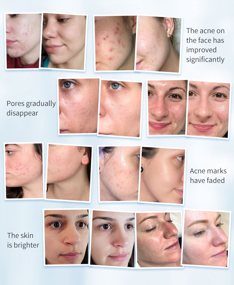 Skin Care Dermabrasion Machines Esthetician Radio Frequency Professional