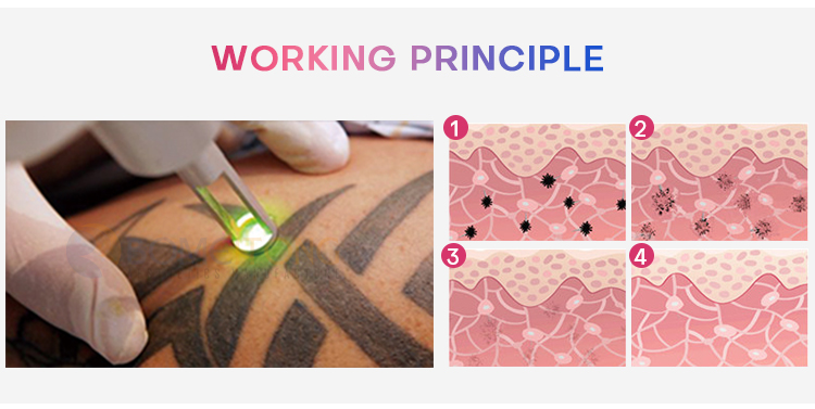 how much are tattoo removal machines