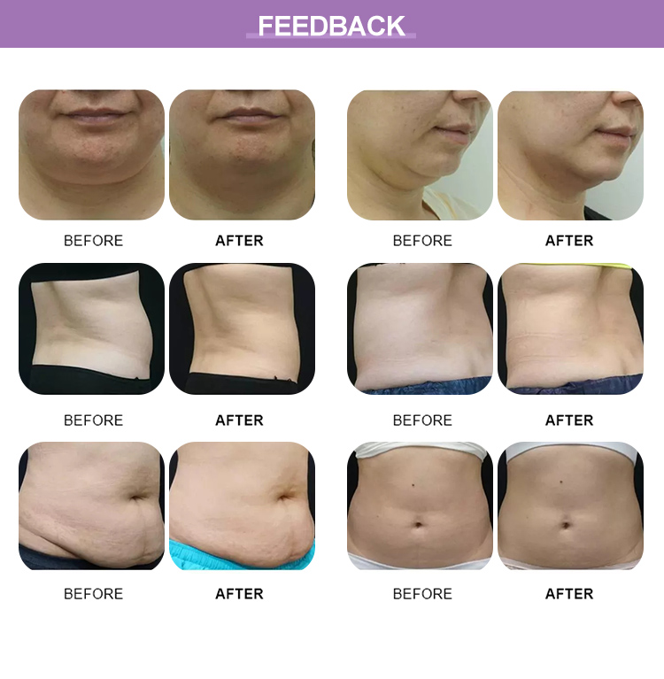 360&deg; Cryolipolysis Fat Freezing Machine for Sale