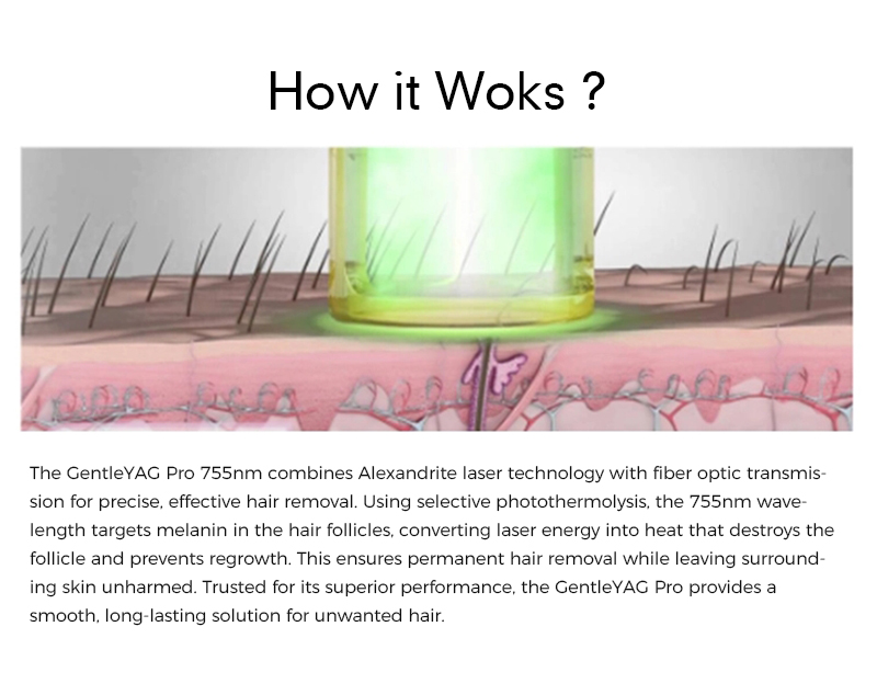 Yag Laser Hair Removal Machine