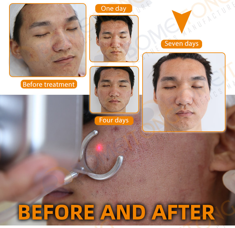 2021 co2 fractional laser skin rejuvenation vaginal tightening device small