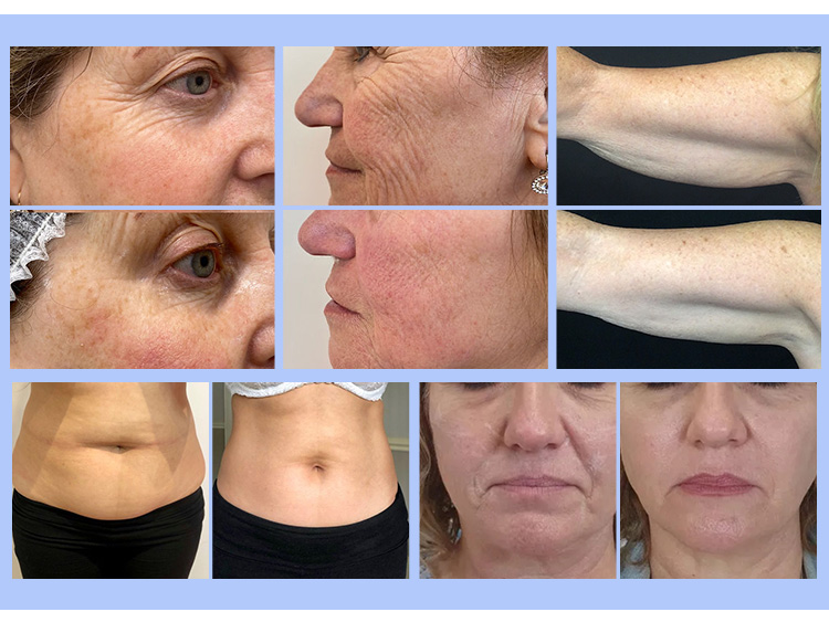 6 in 1 Vertical 360&deg;vignal Hifu Lipo Machine for Sale