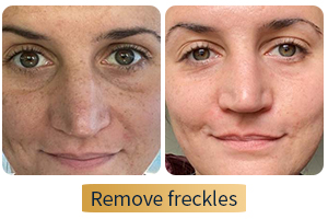 freckle removal