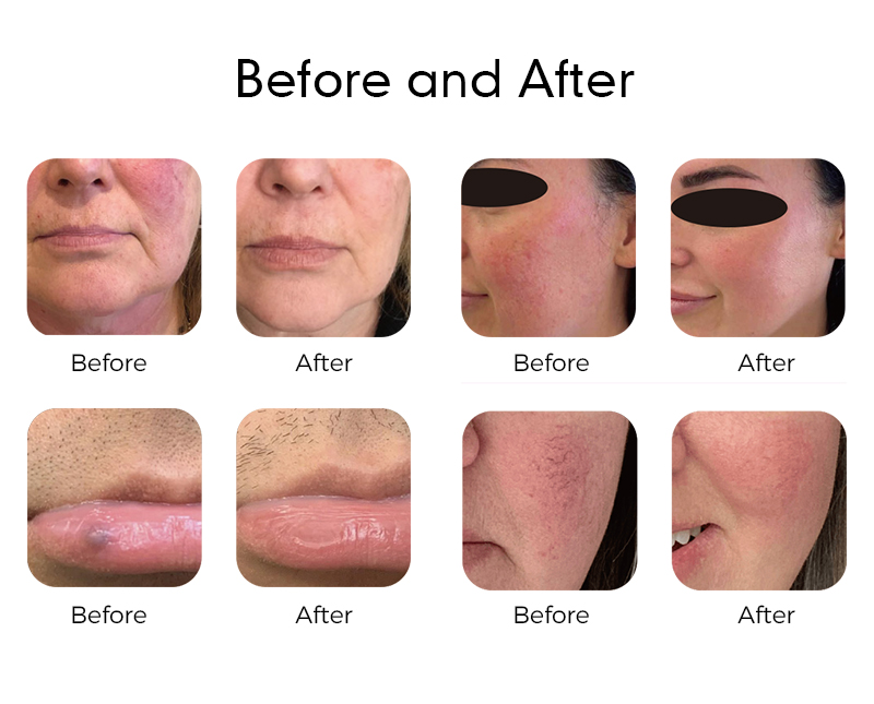 980 nm diode laser spider vein removal machine