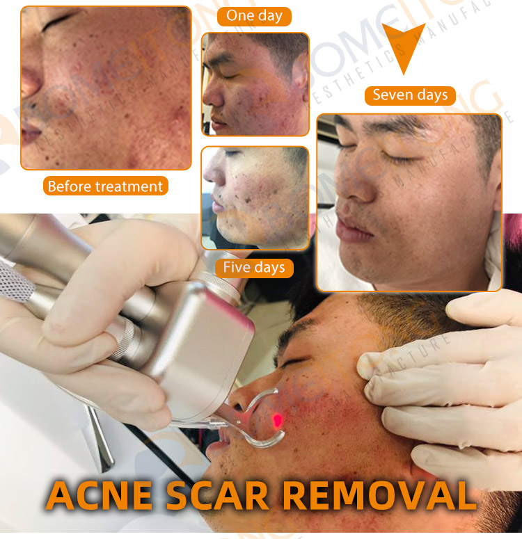 2021 co2 fractional laser skin rejuvenation vaginal tightening device small