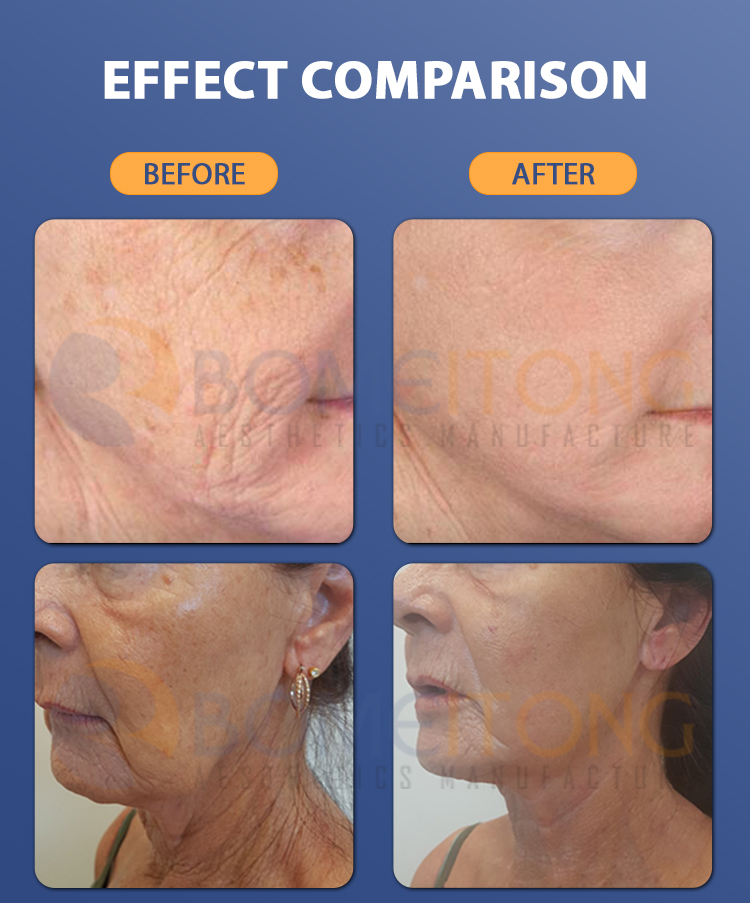 Dermo Electro Poration skin firming ion vibration device Dermoelectroporation