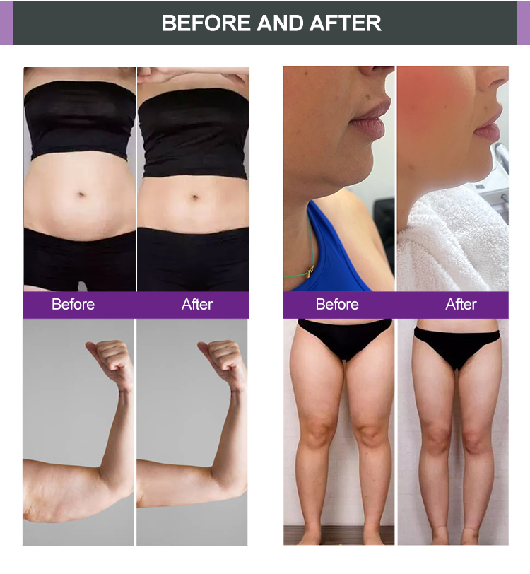 Youshape Machine RF Shaping for body and face