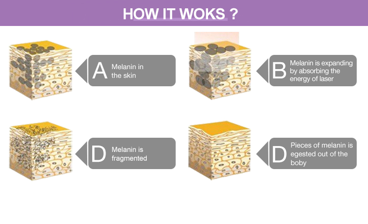 Portable Q Switched Nd Yag Laser Machine BM27