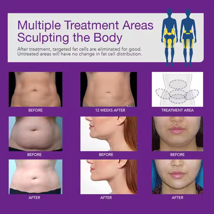 Cryolipolysis Fat Freezing Chin Machine Price in Srilanka