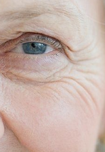 Wrinkle Removal