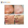 oxygen jet peel facial machine Korea Anti Aging Beauty Jet ance treatment skin Whitening lifting tightening cleaning