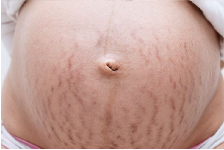 Stretch Marks: Common Causes and Effective Treatment Options