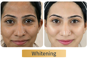 whitening