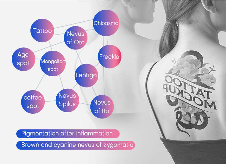 how much are tattoo removal machines