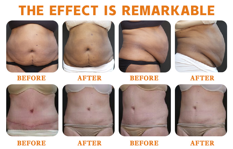 6D lipo fat freeze machine Body Shape slimming cellulite reduction skin tightening