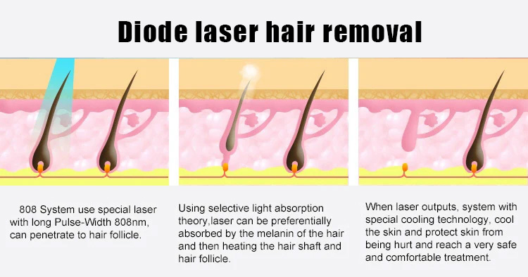 diode-laser-hair-removal
