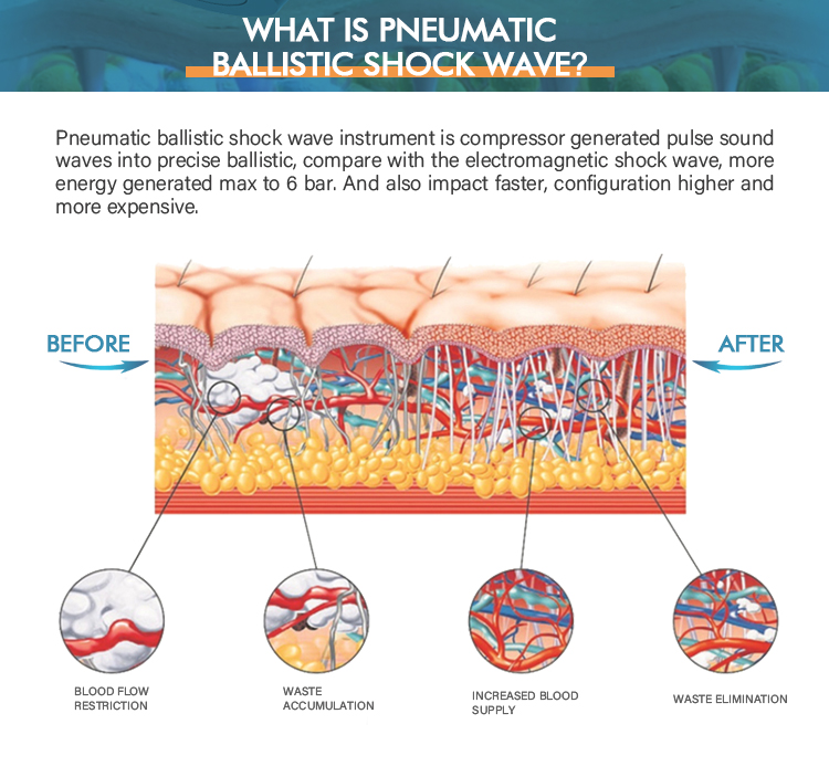 Shock Wave Physiotherapy Machine