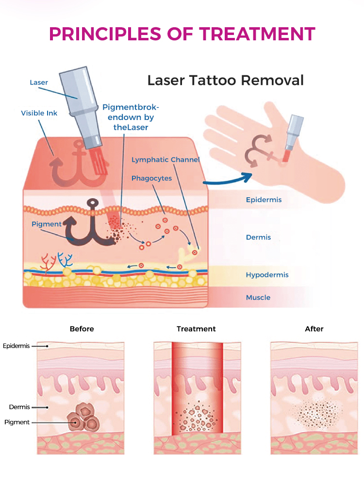 Best Tattoo Eraser Machine Professional