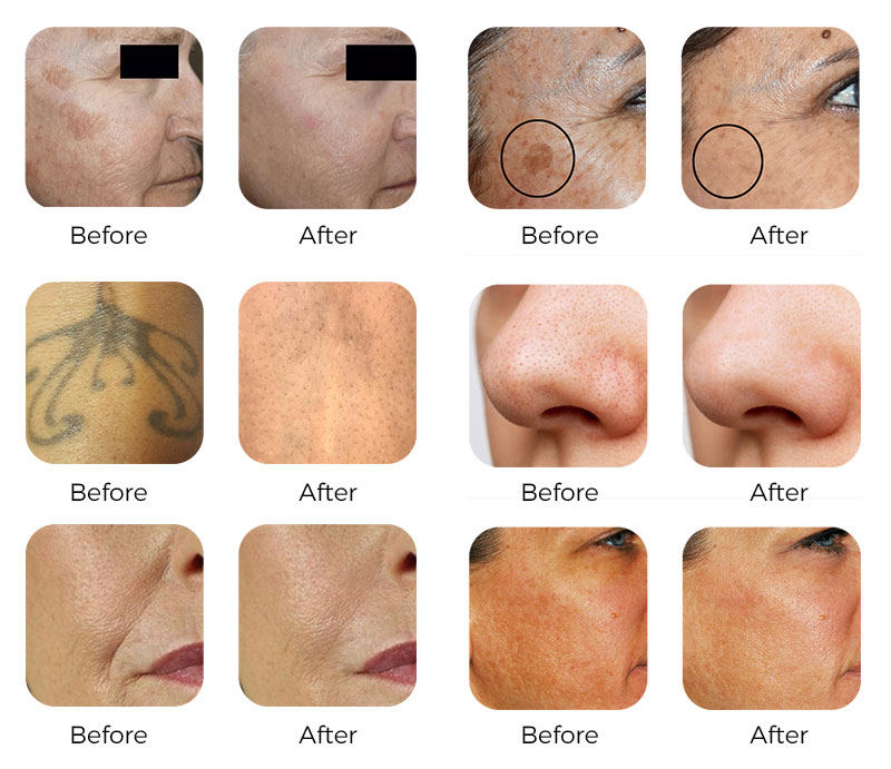 Super Picosecond Laser Tattoo Removal Machine