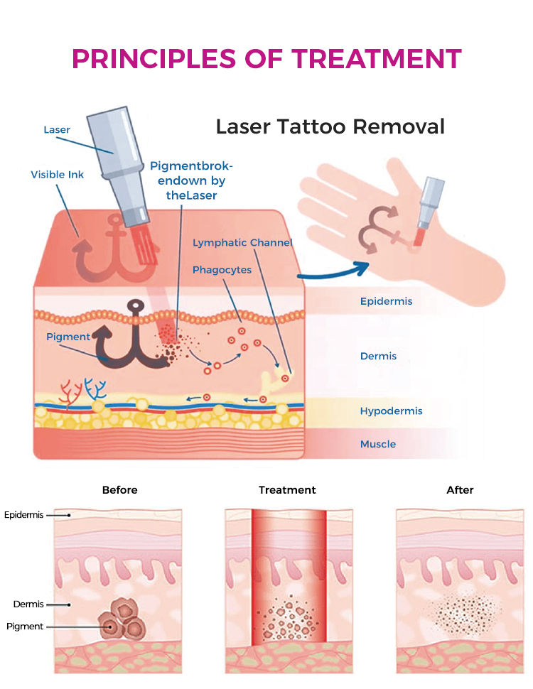 Laser Removal Tattoo Machine