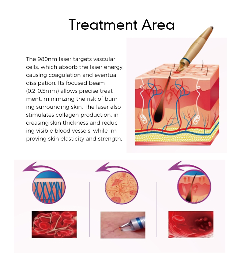 980 nm diode laser spider vein removal machine