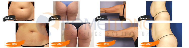 RF lifting cavitation facial cellulite roller massage body slimming shaping machine