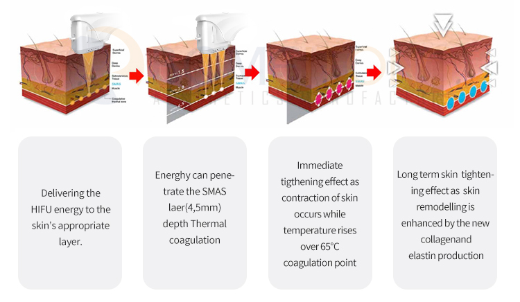 3d Hifu Facial Machine for Face Lifting And Weight Loss