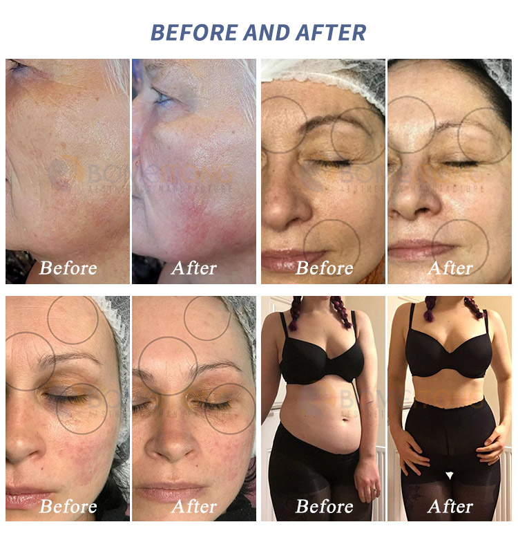 Radio Frequency Magic Pot Rf Machine for Face And Body RV-3s