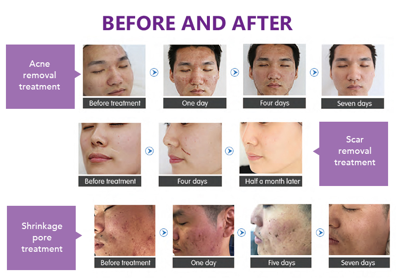 Co2 resurfacing laser machine australia