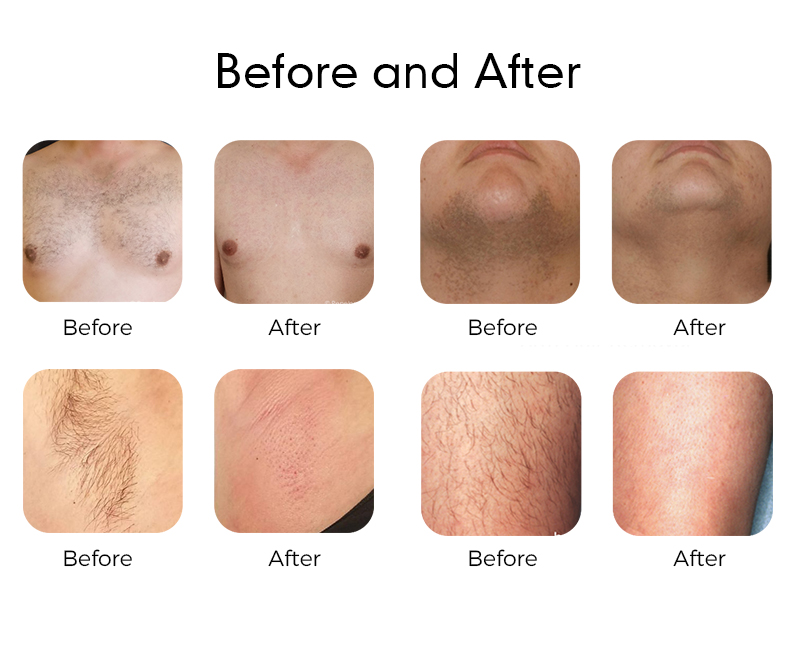 Yag Laser Hair Removal Machine