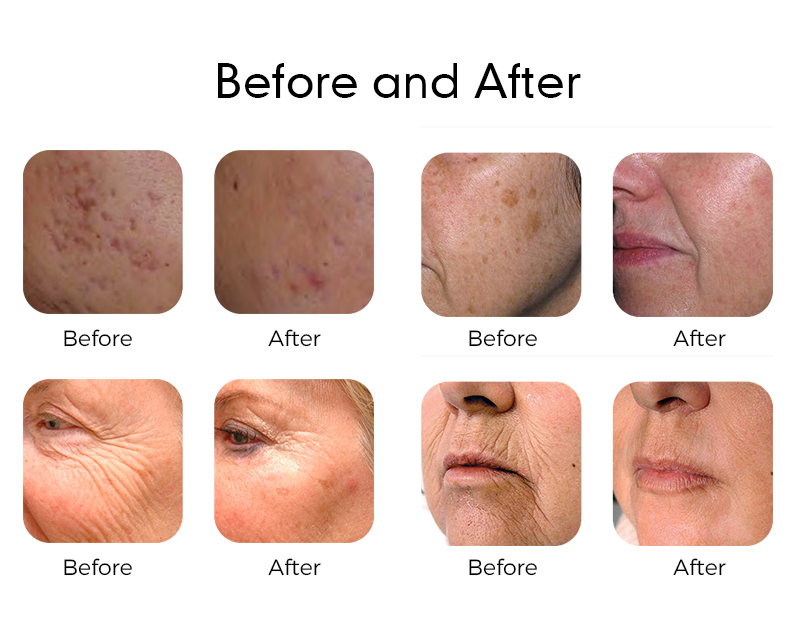 1927nm Fractional Thulium Laser Machine