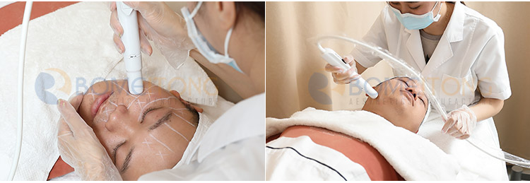 portable hifu device 360 + 12D